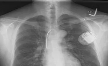 Erori fatale ale implanturilor medicale. Ce au descoperit cercetătorii când au verificat software-ul
